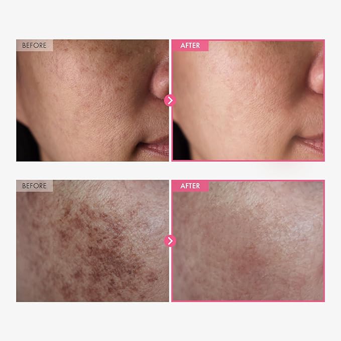 TOSOWOONG Arbutin 7.0 +TXA 4.0 Cream - Target hyperpigmentation, dark spots & uneven skin tone