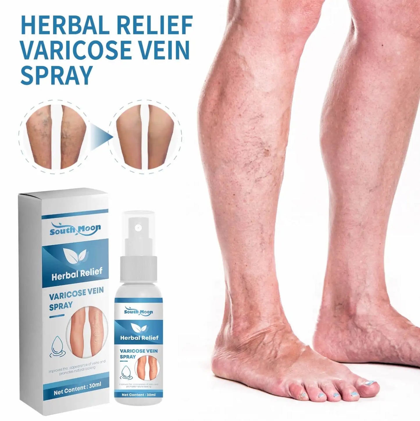 Varicose Veins Treatment Spray - ( BUY 1 GET 1 FREE )