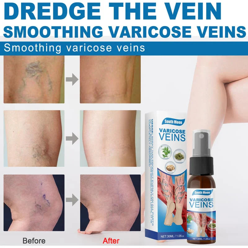 Varicose Veins Treatment Spray - ( BUY 1 GET 1 FREE )