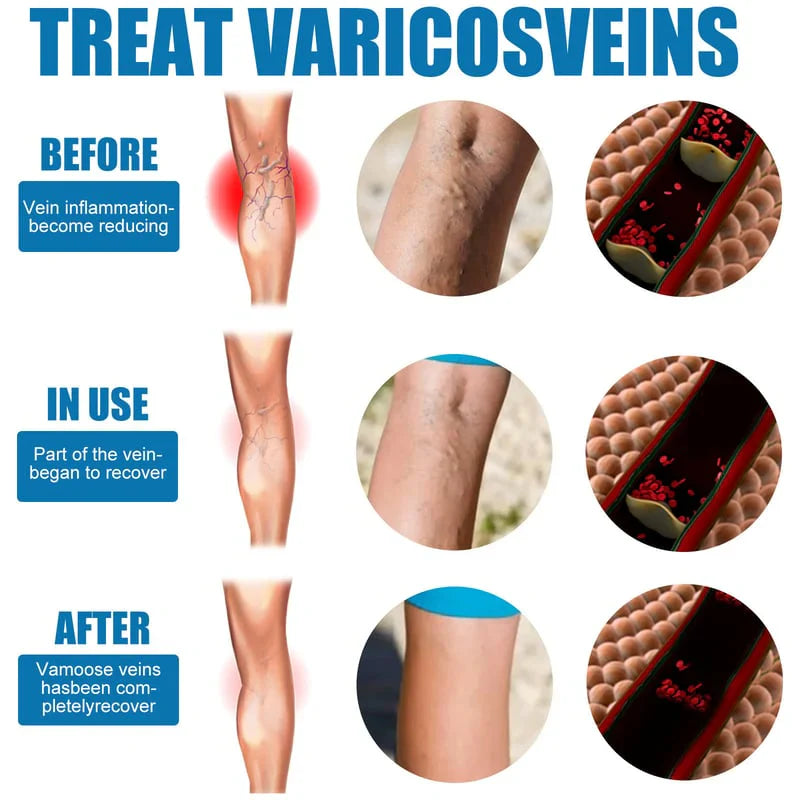 Varicose Veins Treatment Spray - ( BUY 1 GET 1 FREE )